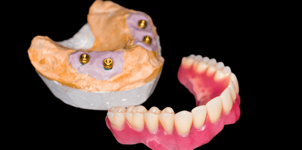 dentures way brisbane implant teeth dental implants supported wondering replace missing